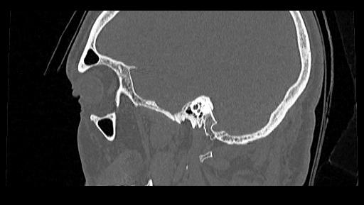 Arcuate foramen (Radiopaedia 89833-106944 Sagittal bone window 125).jpg