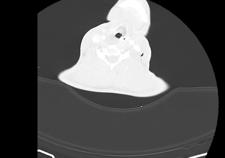 Arrow injury in the neck (Radiopaedia 75268-86390 Axial lung window 191).jpg