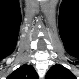 Arteriovenous malformation of the neck (Radiopaedia 53935-60062 D 27).jpg