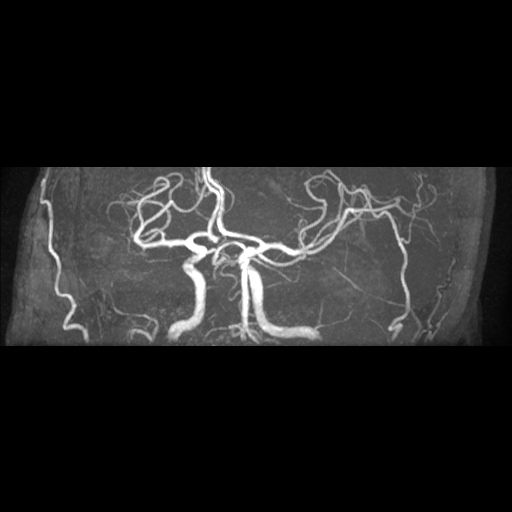 Artery of Percheron infarction (Radiopaedia 27975-28230 3D TOF 8).jpg