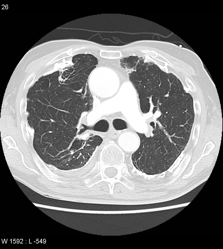 Asbestos related lung and pleural disease (Radiopaedia 14377-14301 A 23).jpg
