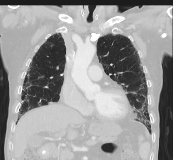 Asbestosis (Radiopaedia 56192-62864 Coronal lung window 20).png