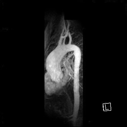 File:Ascending aorta aneurysm (Radiopaedia 5257).jpg