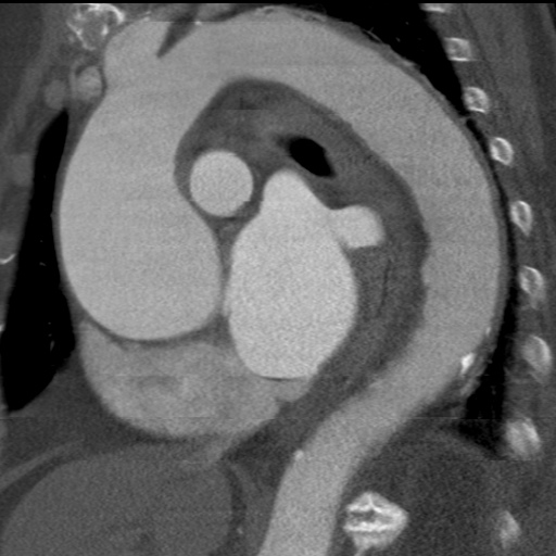 File:Ascending aortic aneurysm (Radiopaedia 20913-20846 A 19).jpg