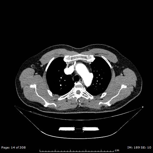 Ascending aortic aneurysm (Radiopaedia 50086-55404 A 1).jpg