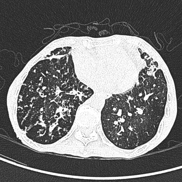 Aspergilloma- with Monod sign (Radiopaedia 44737-48532 Axial lung window 198).jpg