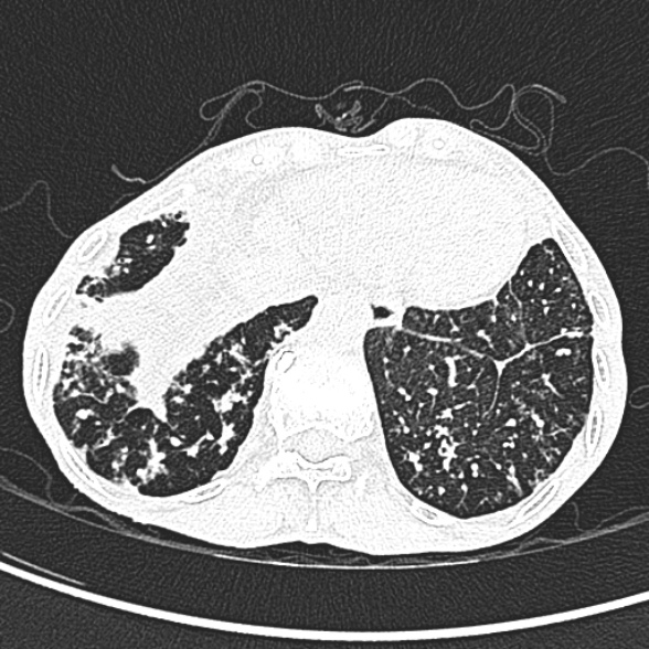 File:Aspergilloma- with Monod sign (Radiopaedia 44737-48532 Axial lung window 251).jpg