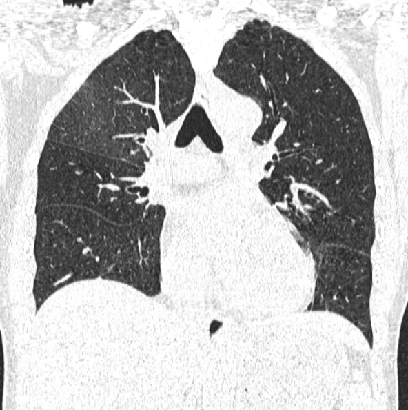 File:Aspergilloma (Radiopaedia 26223-26347 Coronal lung window 26).jpg
