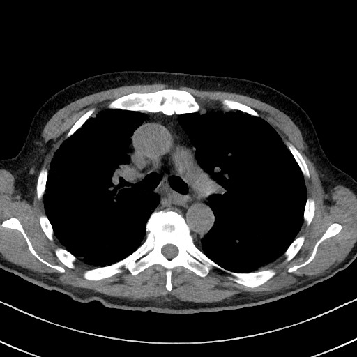 Aspergilloma on background pulmonary fibrosis (Radiopaedia 60942-68757 Axial non-contrast 24).jpg