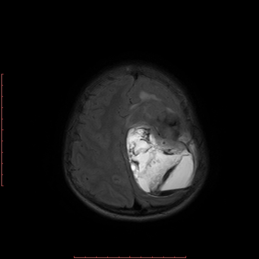 File:Astroblastoma (Radiopaedia 74287-85162 Axial FLAIR 18).jpg
