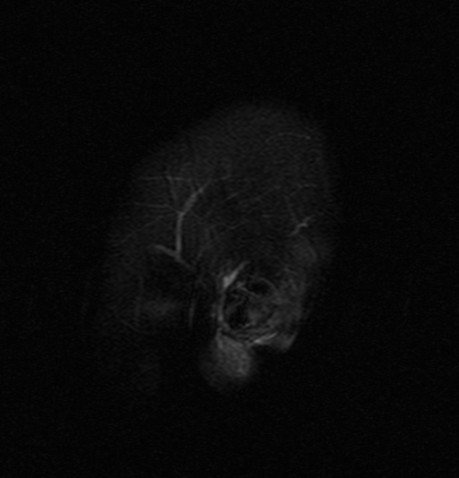 File:Astrocytoma - WHO grade II (Radiopaedia 16279-15959 Sagittal FLAIR 1).jpg