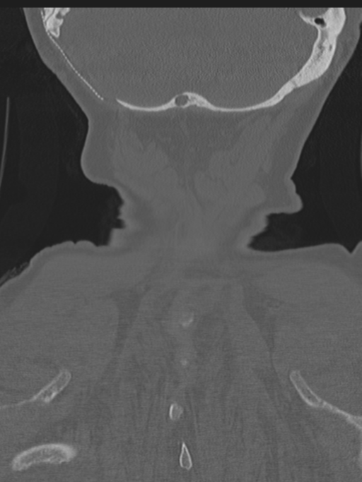 Atlanto-axial subluxation (Radiopaedia 36610-38176 Coronal bone window 49).png