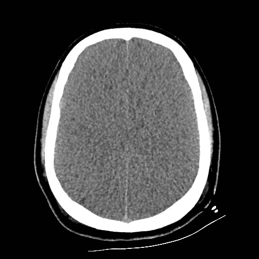 File:Atlanto-occipital dislocation (Radiopaedia 44648-48412 Axial non-contrast 38).jpg