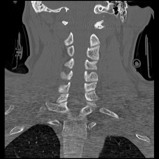 Atlanto-occipital dissociation injury (Radiopaedia 29274-29698 Coronal bone window 20).png