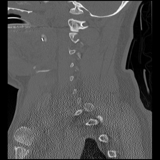 Atlanto-occipital dissociation injury (Radiopaedia 29274-29698 Sagittal bone window 17).png