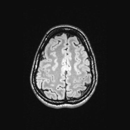 Atretic encephalocoele with inferior vermis hypoplasia (Radiopaedia 30443-31108 Axial 123).jpg