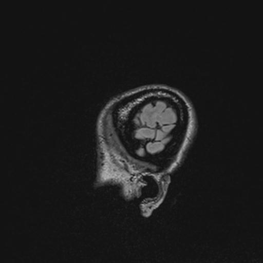 Atretic encephalocoele with inferior vermis hypoplasia (Radiopaedia 30443-31108 Sagittal FLAIR 20).jpg