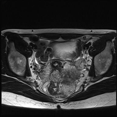 File:Atypical deep infiltrating endometriosis (Radiopaedia 44470-48125 Axial T2 17).jpg