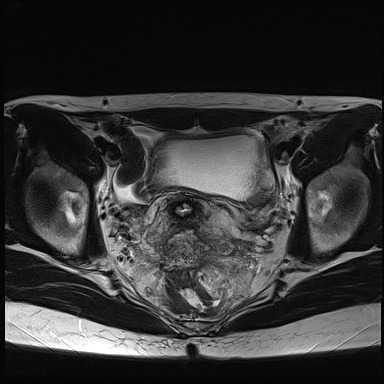 File:Atypical deep infiltrating endometriosis (Radiopaedia 44470-48125 Axial T2 18).jpg