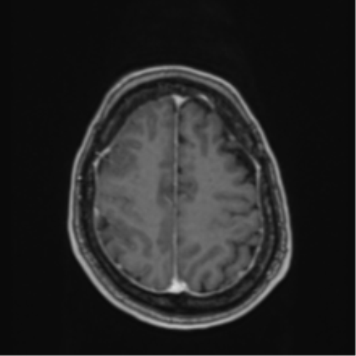 Atypical meningioma (WHO Grade II) (Radiopaedia 54742-60979 Axial T1 C+ 53).png