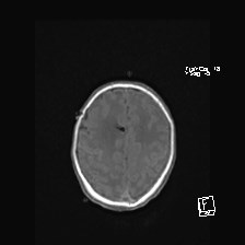 Atypical teratoid rhabdoid tumor (prenatal US and neonatal MRI) (Radiopaedia 59091-66388 Axial T1 46).jpg