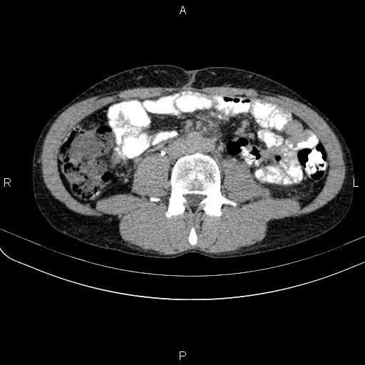 Autoimmune pancreatitis (Radiopaedia 84925-100431 Axial C+ delayed 48).jpg