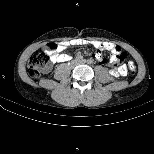 File:Autoimmune pancreatitis (Radiopaedia 84925-100431 Axial C+ delayed 51).jpg