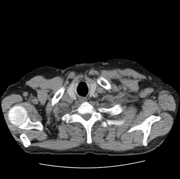 Autosomal dominant polycystic kidney disease (Radiopaedia 27851-28094 Axial non-contrast 2).jpg