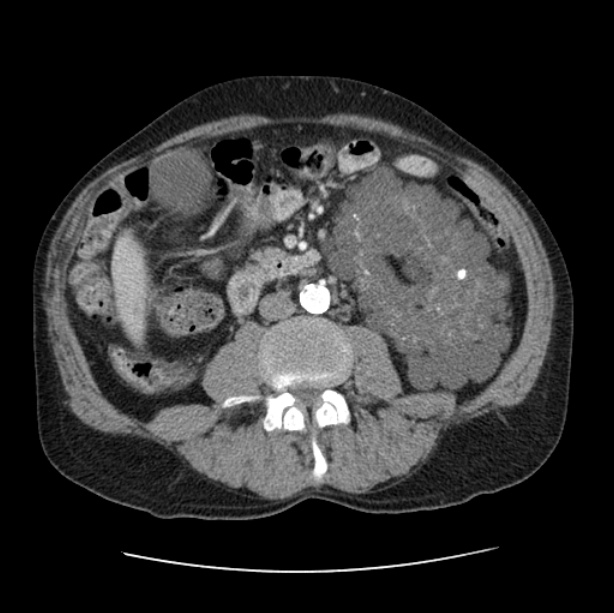 Autosomal dominant polycystic kidney disease (Radiopaedia 27851-28094 B 79).jpg