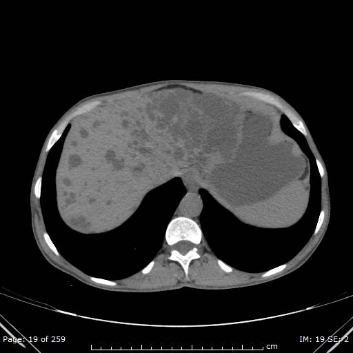 Autosomal dominant polycystic kidney disease (Radiopaedia 44122-47684 Axial non-contrast 7).jpg