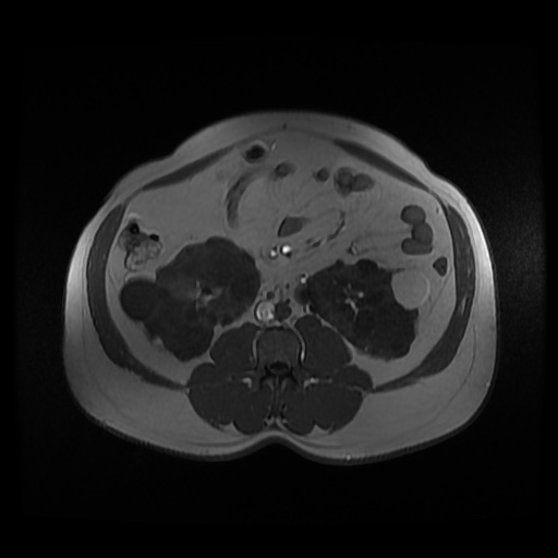 Autosomal dominant polycystic kidney disease (Radiopaedia 50259-55611 Axial 2D Dual Echo 58).jpg