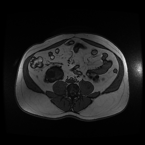 Autosomal dominant polycystic kidney disease (Radiopaedia 50259-55611 Axial 2D Dual Echo 67).jpg