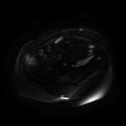 File:Autosomal dominant polycystic kidney disease (Radiopaedia 50259-55611 Axial DWI 71).jpg