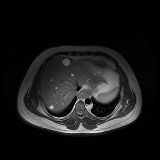 File:Autosomal dominant polycystic kidney disease (Radiopaedia 50259-55611 Axial T2 6).jpg