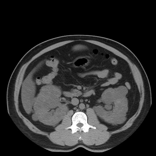 File:Autosomal dominant polycystic kidney disease (Radiopaedia 50259-55612 Axial non-contrast 38).jpg