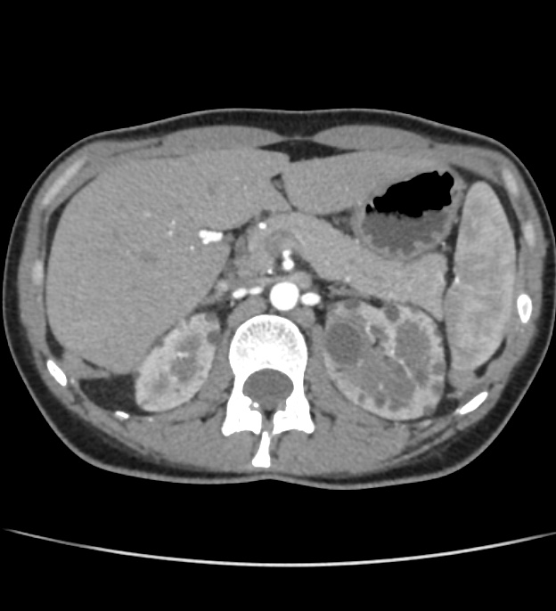 Autosomal dominant polycystic kidney disease - early onset (Radiopaedia 40734-43387 B 11).jpg
