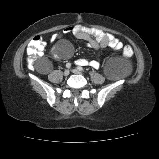 Autosomal dominant polycystic kidney disease with hepatic involvement (Radiopaedia 32693-33662 B 54).jpg