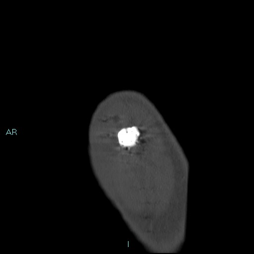 File:Avascular necrosis after fracture dislocations of the proximal humerus (Radiopaedia 88078-104653 Sagittal bone window 9).jpg