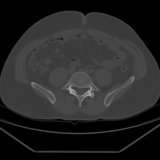 File:Avascular necrosis of the hip (Radiopaedia 61503-69467 Axial bone window 4).jpg