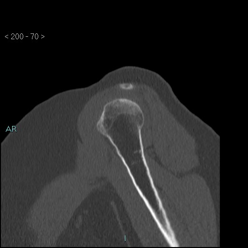 Avascular necrosis of the shoulder - Cruess stage I (Radiopaedia 77674-89887 Sagittal bone window 69).jpg