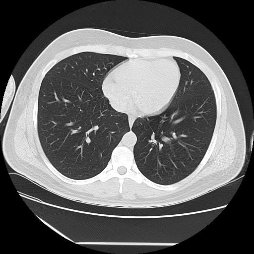Azygos fissure (Radiopaedia 88181-104784 Axial lung window 35).jpg