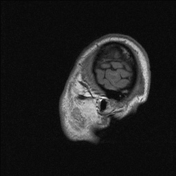 Balo concentric sclerosis (Radiopaedia 50458-55940 Sagittal T1 143).jpg