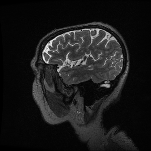 Balo concentric sclerosis (Radiopaedia 53875-59982 Sagittal 3D FSE 48).jpg