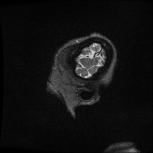 Balo concentric sclerosis (Radiopaedia 53875-59982 Sagittal 3D FSE 9).jpg