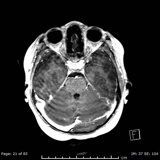Balo concentric sclerosis (Radiopaedia 61637-69636 Axial T1 C+ 21).jpg