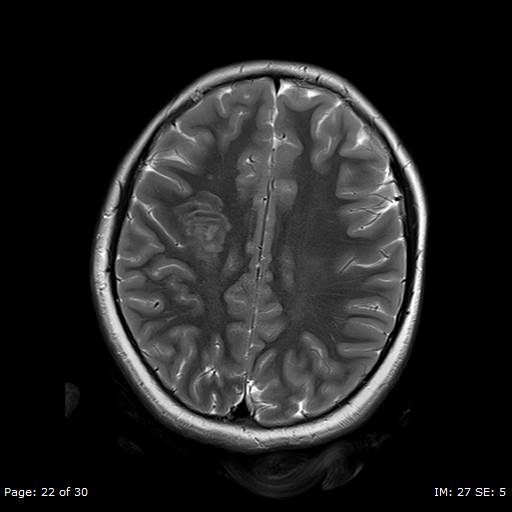 Balo concentric sclerosis (Radiopaedia 61637-69636 I 163).jpg