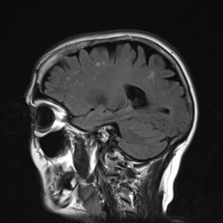 File:Base of skull chondrosarcoma (Radiopaedia 30410-31070 Sagittal FLAIR 17).jpg