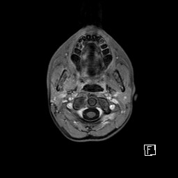 Base of skull rhabdomyosarcoma (Radiopaedia 32196-33142 T1 C+ fat sat 16).jpg