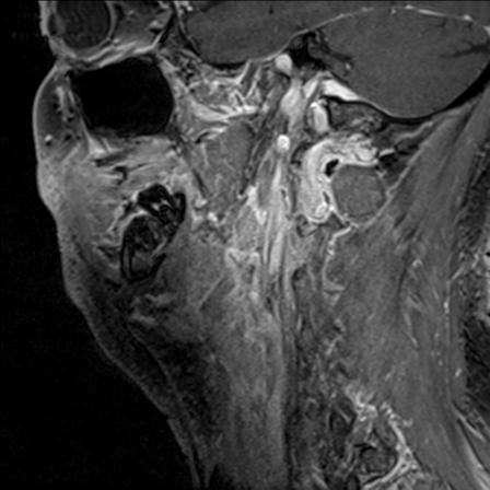 File:Base of tongue squamous cell carcinoma (Radiopaedia 31174-31884 F 53).jpg