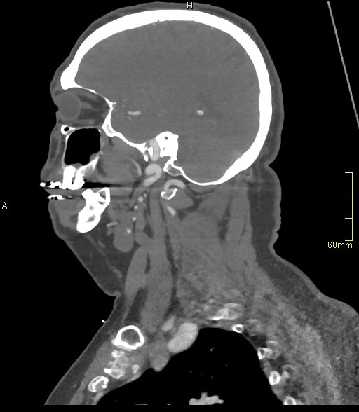 Basilar artery aneurysm (Radiopaedia 56261-62932 C 8).jpg
